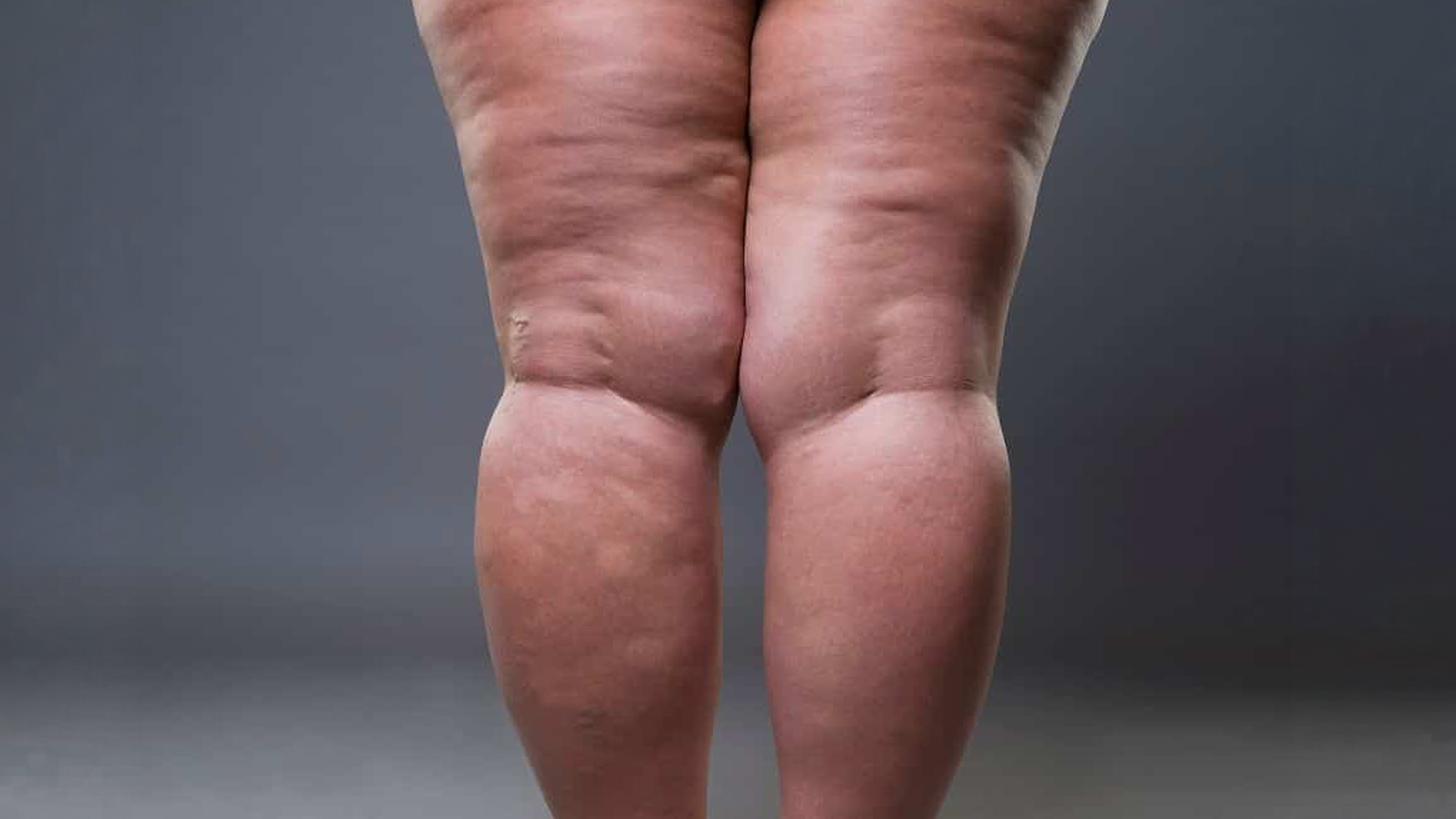 Traitement du lipœdème avec la Clinique du lipœdème