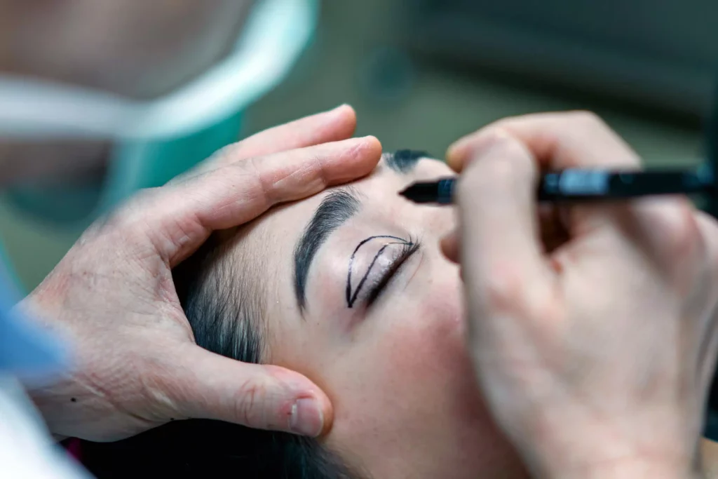 BLEPHAROPLASTIE